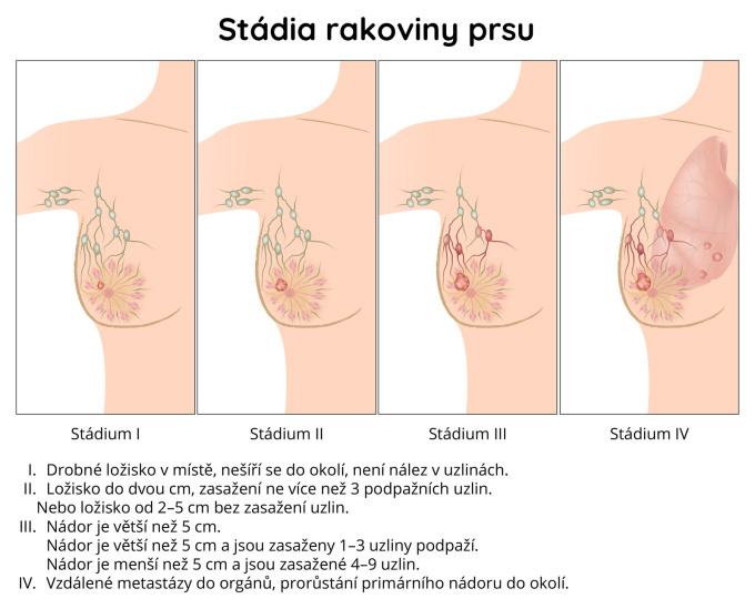 Stádia rakoviny prsu