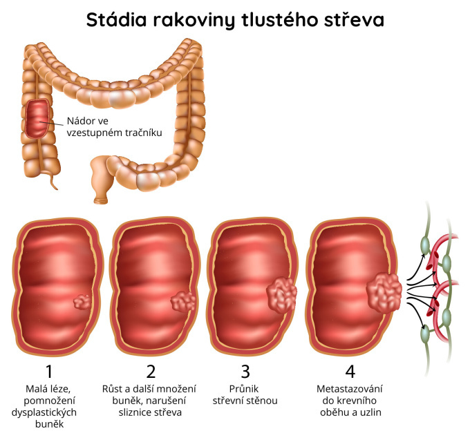 Stádia rakoviny tlustého střeva