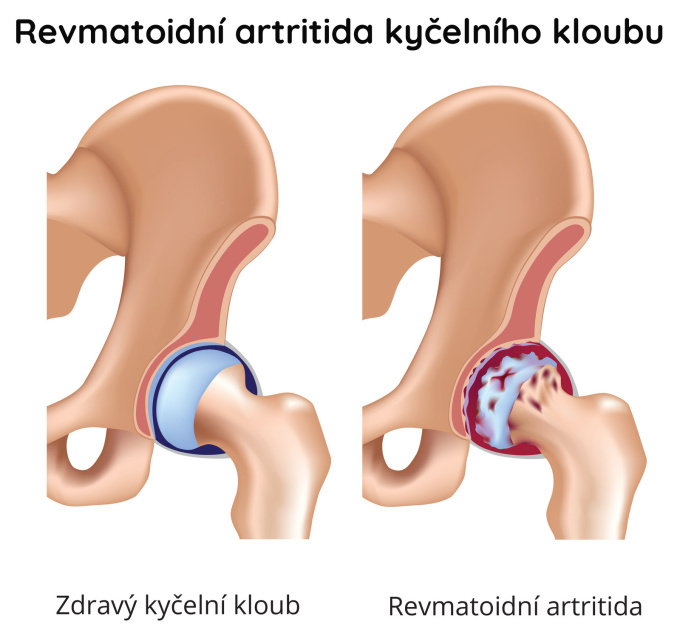 Revmatoidní artritida kyčelního kloubu