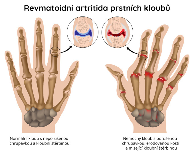 Prstní klouby postižené revmatoidní artritidou