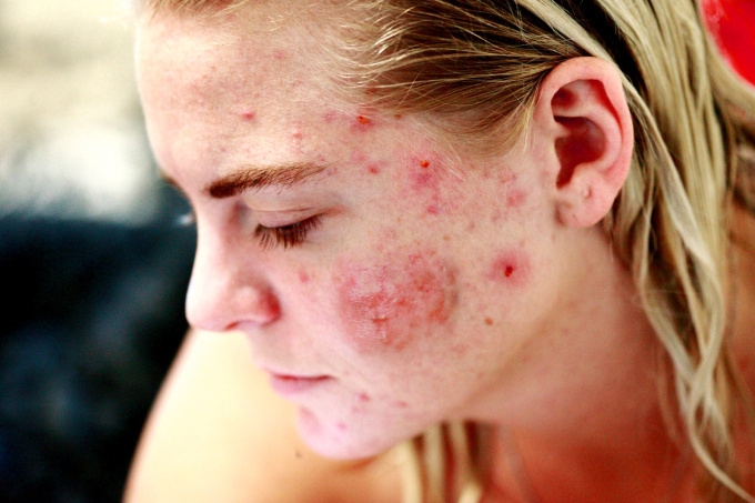 Rosacea (růžovka)