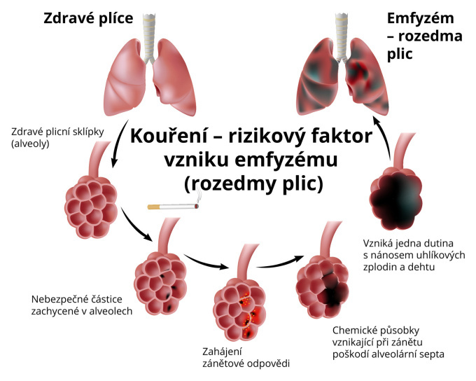 Kouření je rizikový faktor vzniku rozedmy plic
