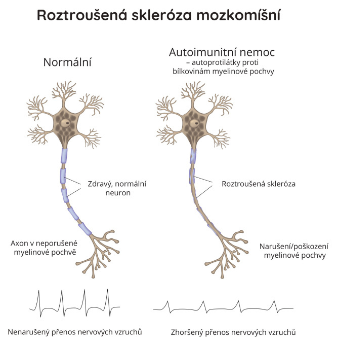 Roztroušená skleróza mozkomíšní