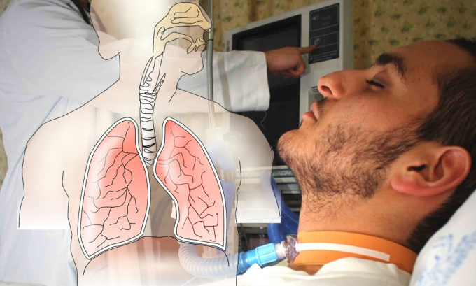 Těžký akutní respirační syndrom, syndrom náhlého selhání dýchání (SARS)