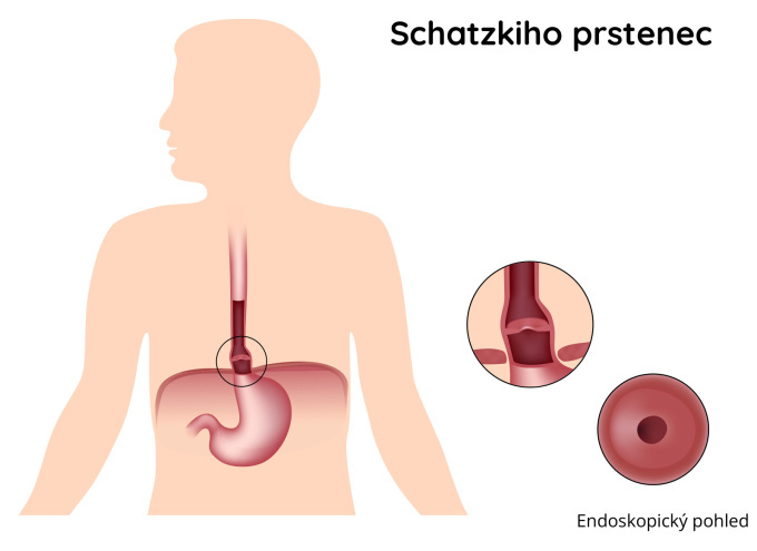 Schatzkiho prstenec