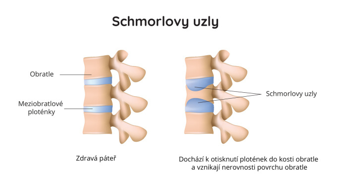 Schmorlovy uzly