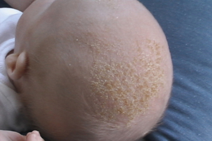 Seboroická dermatitida