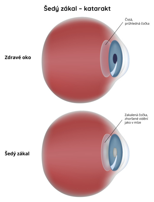 Šedý zákal - katarakt