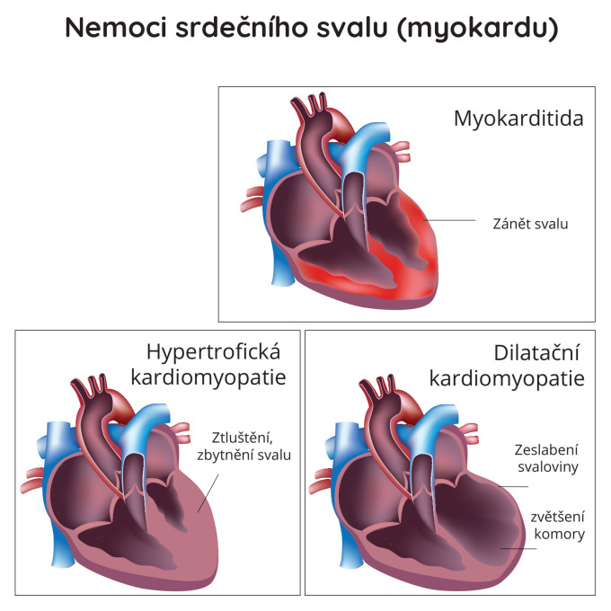Nemoci srdečního svalu (myokardu)