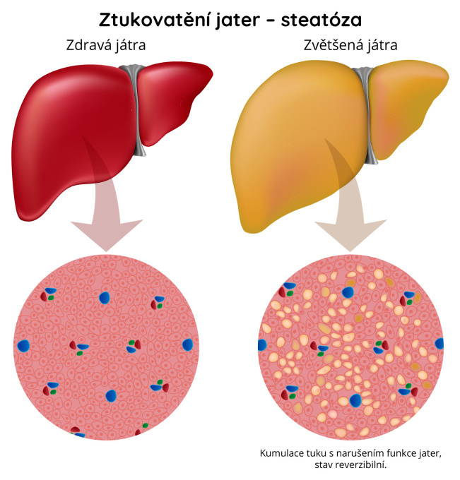 Ztukovatění jater – steatóza
