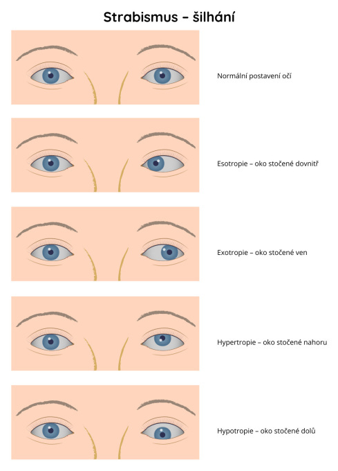 Strabismus – šilhání