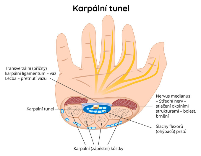 Karpální tunel