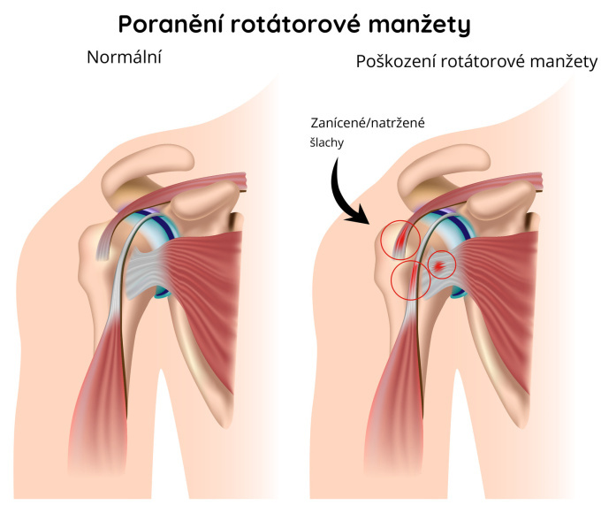 Syndrom manžety rotátoru
