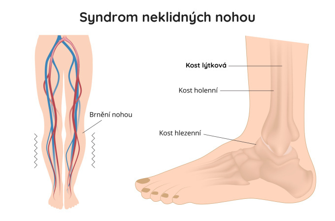 Neklidné nohy