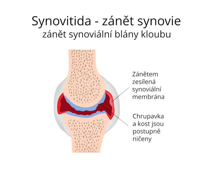 Synovitida - zánět synoviální blány kloubu