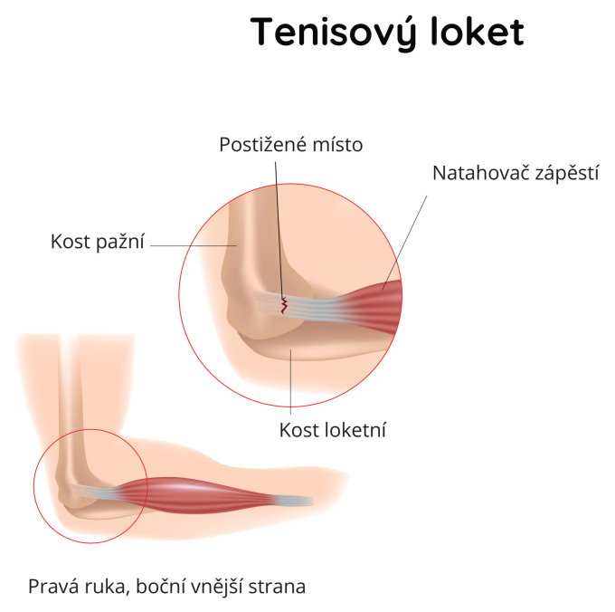 Tenisový loket