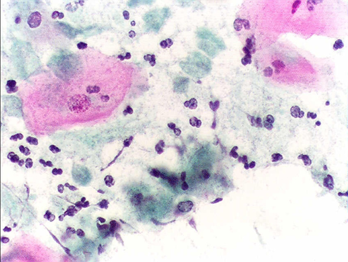 Trichomonas vaginalis