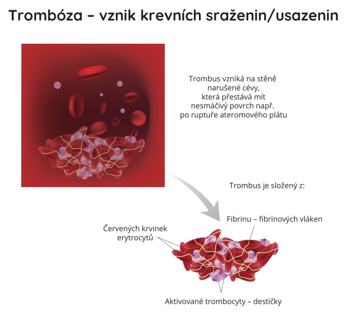 Vznik krevních sraženin a&nbsp;usazenin