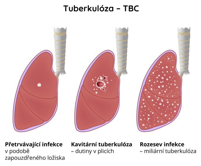 Tuberkulóza (TBC)