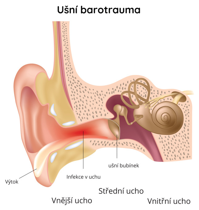 Ušní barotrauma