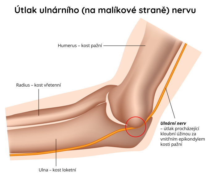 Útlak ulnárního nervu