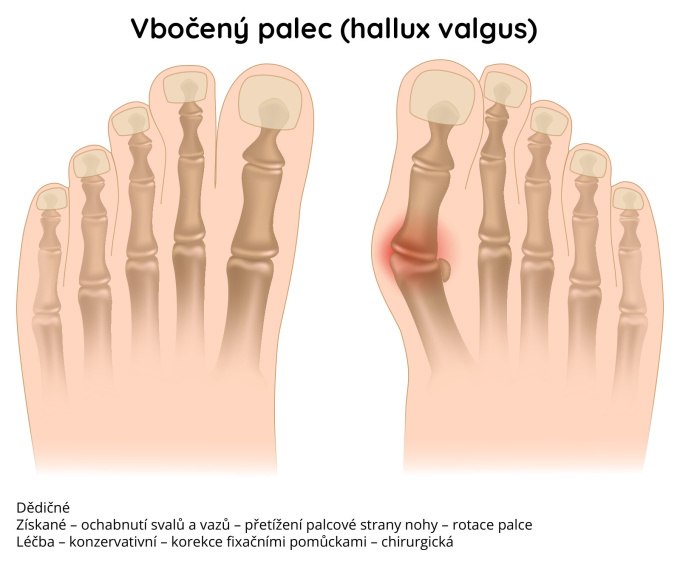 Vbočený palec – hallux valgus