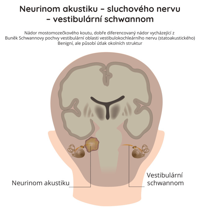 Neurinom akustiku (sluchového nervu) - vestibulární schwannom