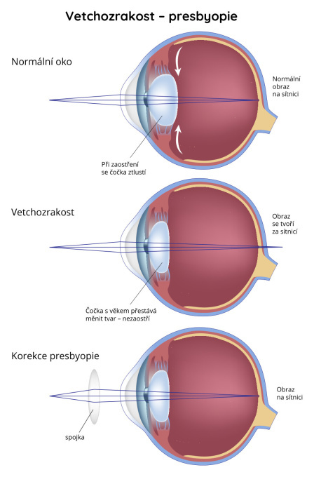 Vetchozrakost (presbyopie)