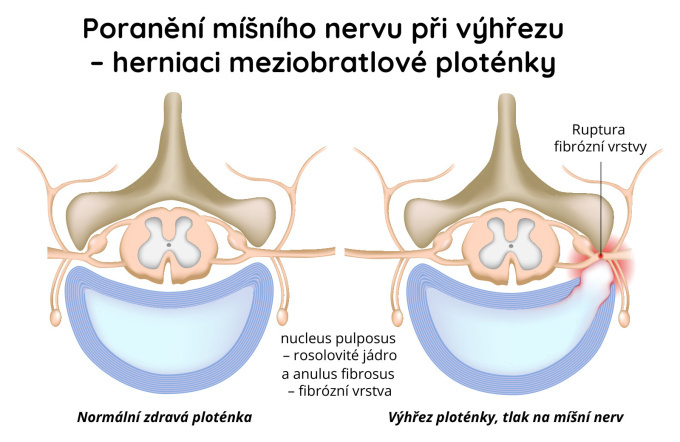 Poranění míšního nervu při výhřezu (herniaci) meziobratlové ploténky