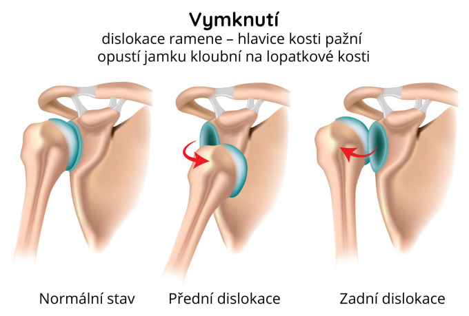 Vymknutí – dislokace ramene