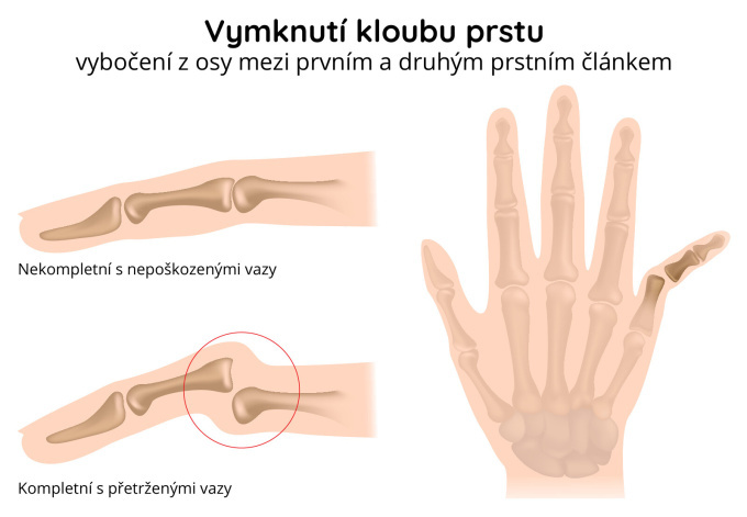 Vymknutí kloubu prstu