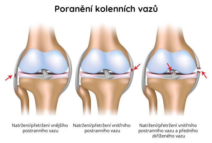 Poranění kolenních vazů