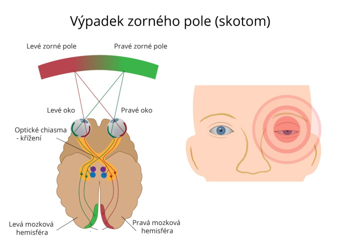 Výpadek zorného pole (skotom)