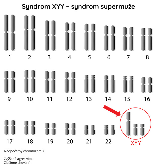 Syndrom XYY - syndrom supermuže
