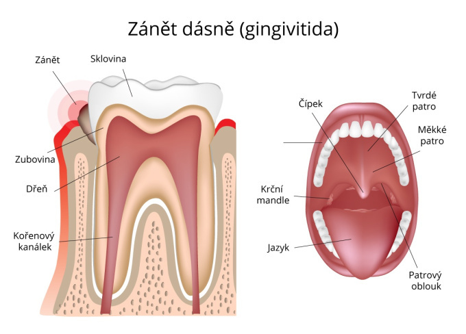 Zánět dásně