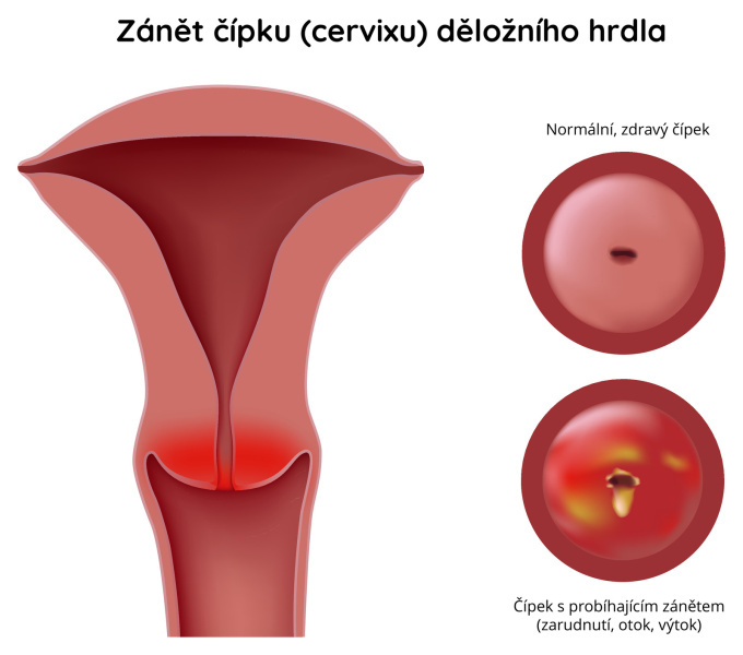 Zánět čípku děložního hrdla