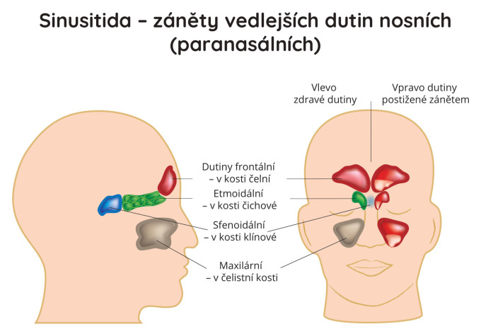 Sinusitida - záněty vedlejších dutin nosních (paranasálních)