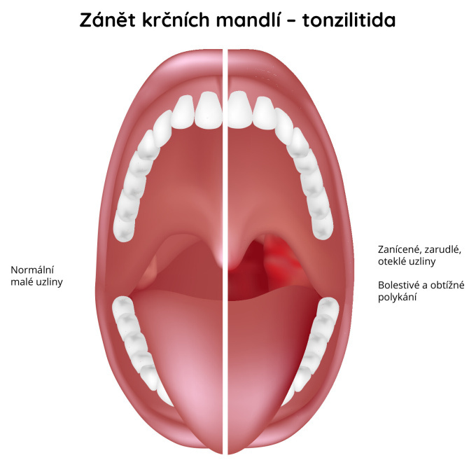 Zánět-krčních-mandlí - Tonzilitida 