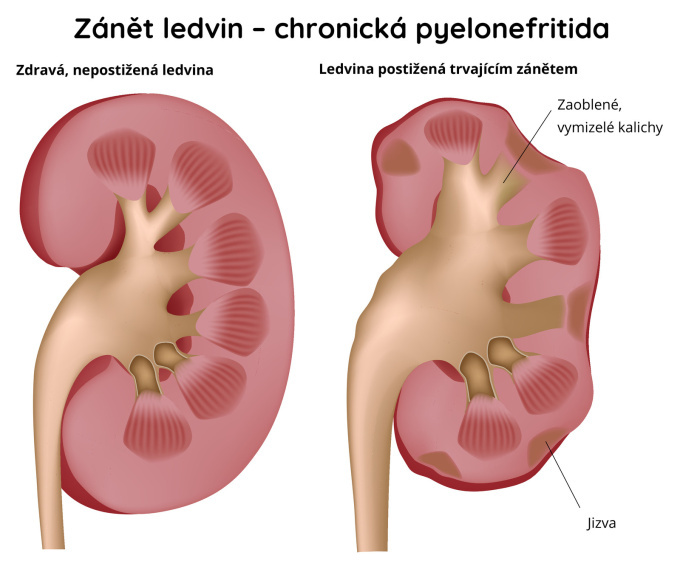 Zánět ledvin - chronická pyelonefritida