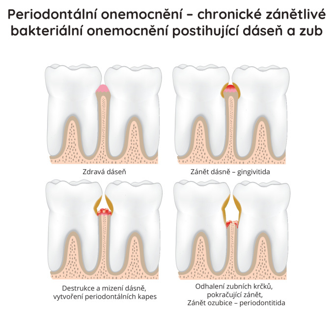 Periodontalni onemocnění