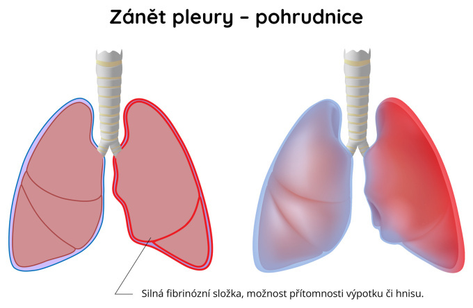 Zánět pleury (pohrudnice) - Pleuritida
