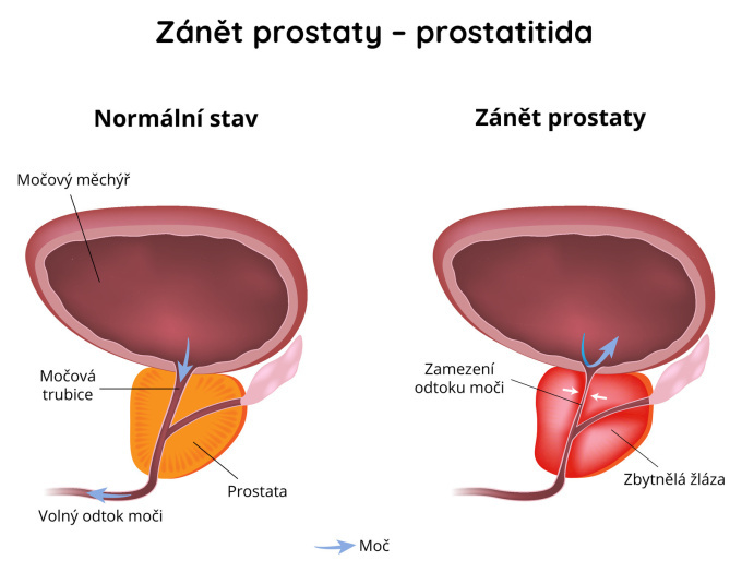 Zánět prostaty (prostatitida)