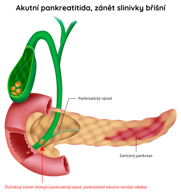 Akutní pankreatitida - zánět slinivky břišní