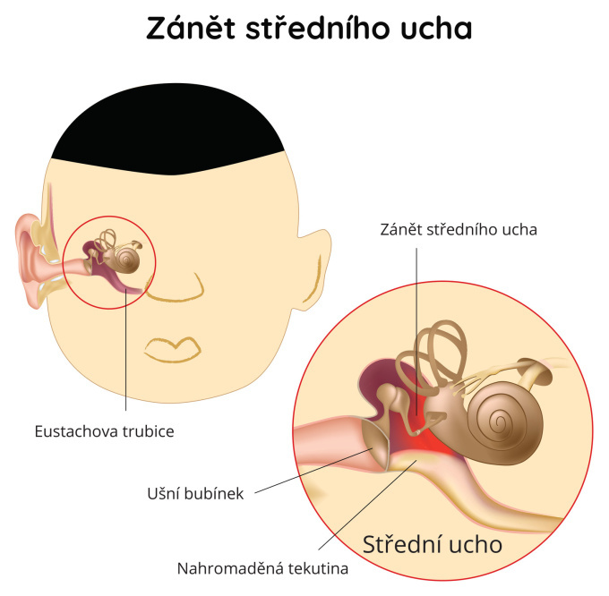 Zánět středního ucha