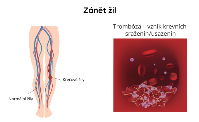 Zánět žil