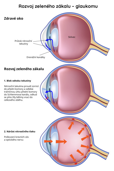 Rozvoj zeleného zákalu - glaukomu