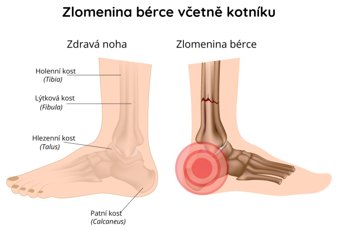 Zlomený kotník