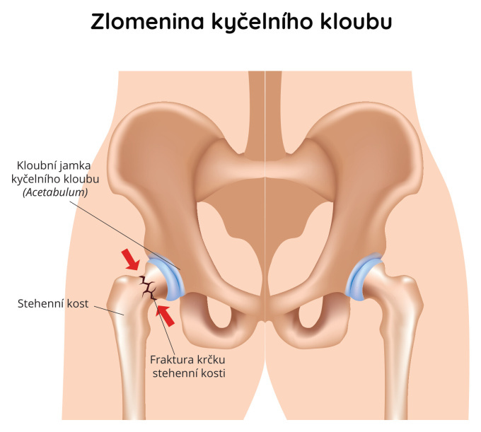 Zlomenina kyčelního kloubu