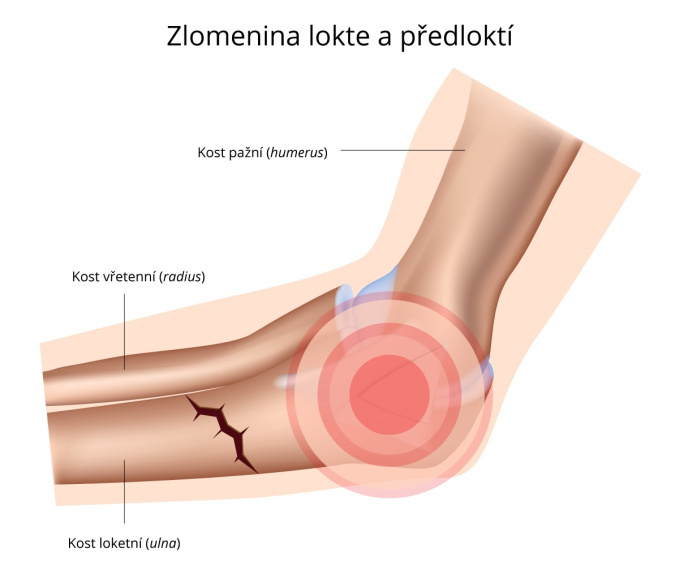 Zlomený loket a předloktí