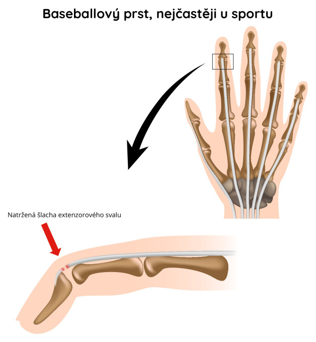 Baseballový prst, nejčastější u sportu
